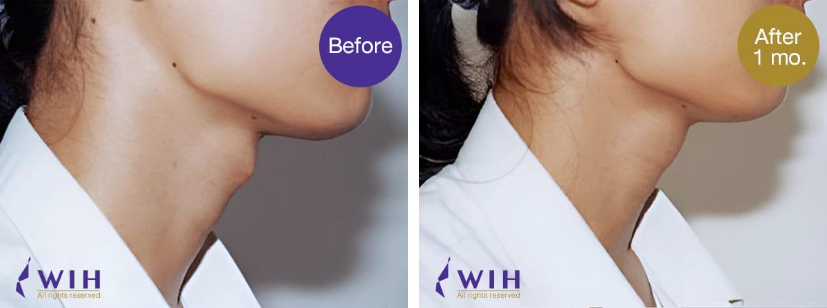 เหลากระเดือก โรงพยาบาล ดับเบิลยูไอเอช รูปก่อนผ่าตัด