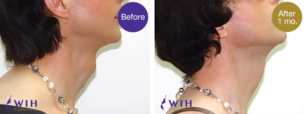 เหลากระเดือก โรงพยาบาล ดับเบิลยูไอเอช รูปก่อนผ่าตัด