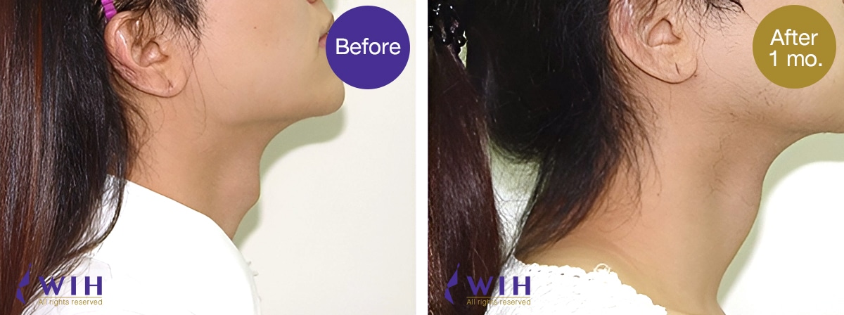 เหลากระเดือก โรงพยาบาล ดับเบิลยูไอเอช รูปก่อนผ่าตัด