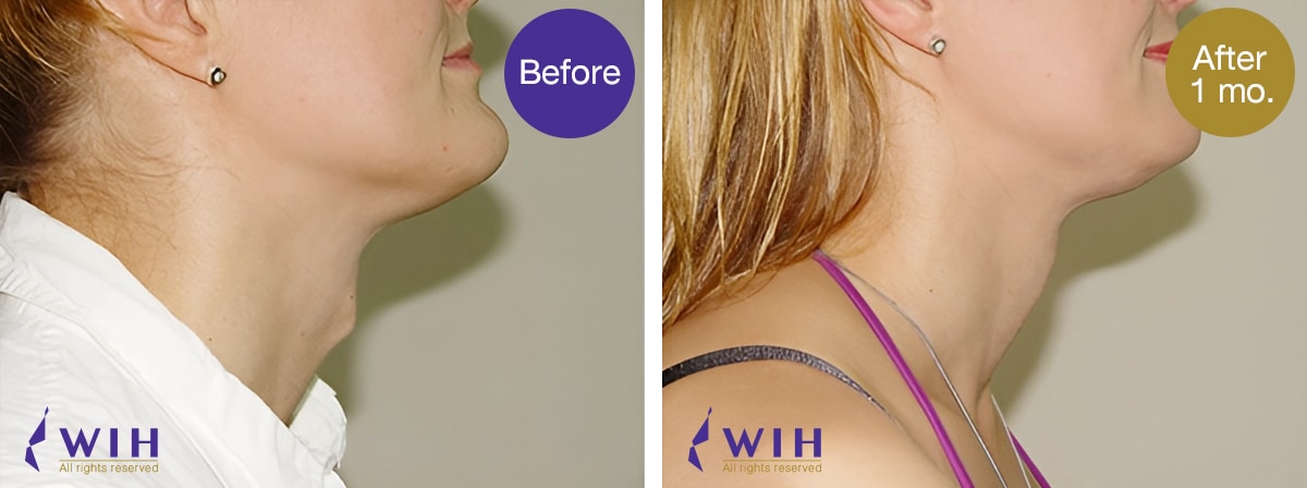 เหลากระเดือก โรงพยาบาล ดับเบิลยูไอเอช รูปก่อนผ่าตัด