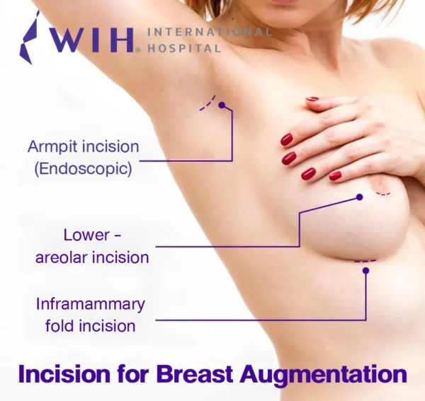 Incision-for-Breast-Augmentation-1-600x567